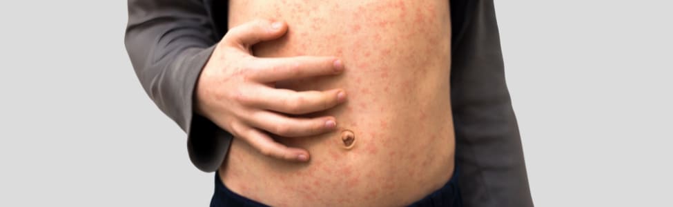 sick child body stomach with red rush spots